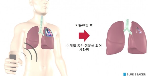 무선 약물전달 의료기기 개념도